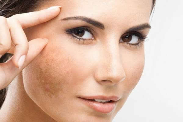 Como evitar manchas de melasma na pele?